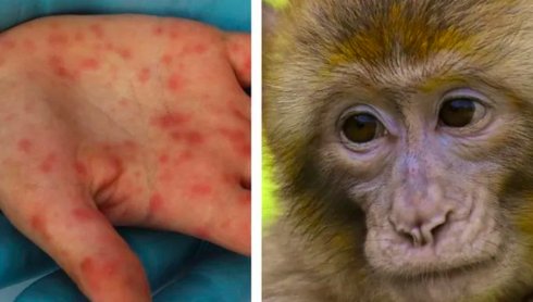 OMS, avertizare importantă despre variola maimuței! NU E DE GLUMĂ