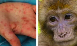 OMS, avertizare importantă despre variola maimuței! NU E DE GLUMĂ