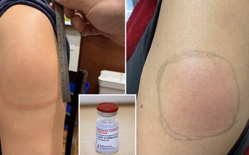 Reacție adversă a vaccinului Moderna, supranumită „braț Covid”: o pată roșie umflată, adesea dureroasă la atingere