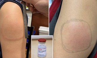 Reacție adversă a vaccinului Moderna, supranumită „braț Covid”: o pată roșie umflată, adesea dureroasă la atingere