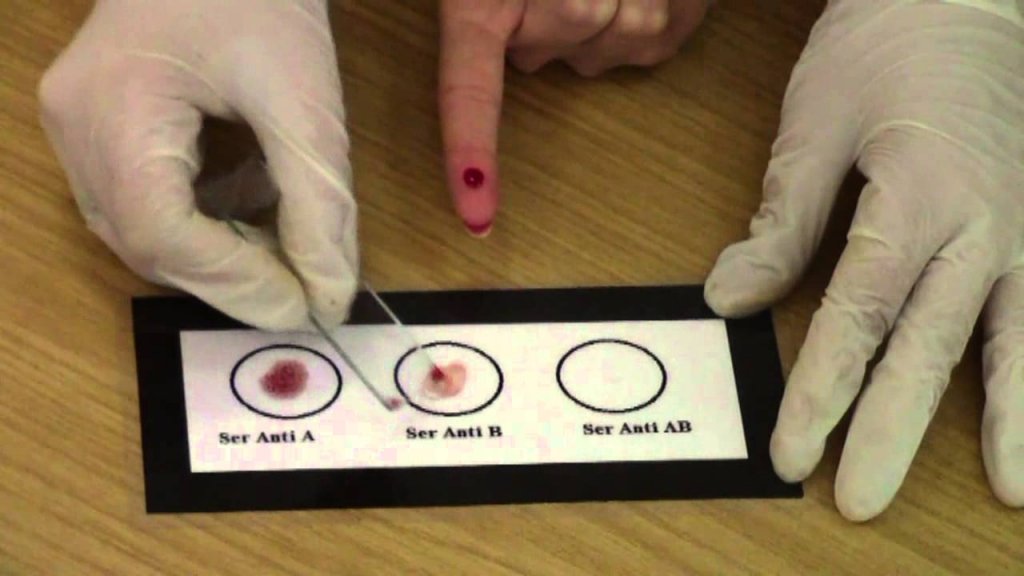 Ce grupă de sânge te face mai sensibil în fața infectării cu SARS-CoV-2